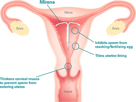 275-mirena-uterus-chart.jpg